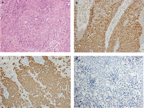 Correlation Of Dlc1 Gene Methylation With Oncogenic Pik3ca Mutations In