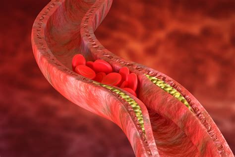 Aterosclerosis S Ntomas Causas Y Tratamiento Muy Salud