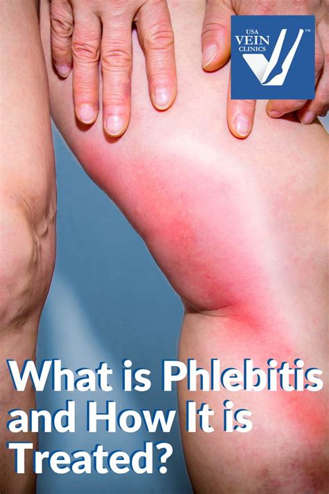 What Is Phlebitis And How Is It Treated Usa Vein Clinics Vein Clinic Superficial Veins