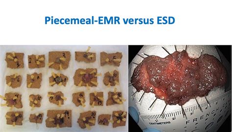 Is Endoscopic Submucosal Dissection Esd Ready To Enter Center Stage For The Resection Of Large