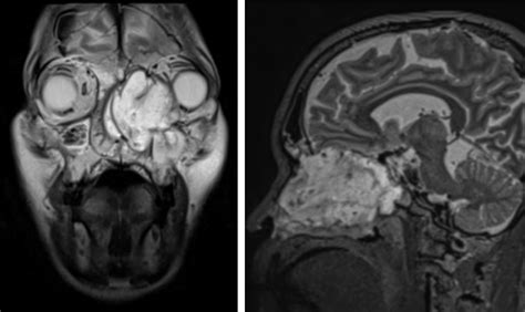 Ethmoid Sinus Malignancy