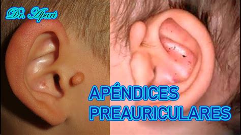 Apendices Preauriculares Ap Ndice Auricular Accesorio Qu Considerar