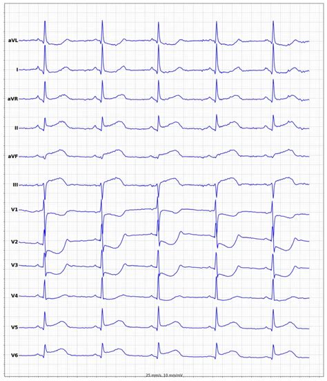 Stemi St Elevation Myocardial Infarction Diagnosis Off