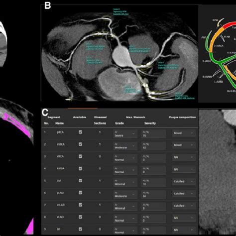 Ai Algorithms For Cac Agatston Score Ccta Plaque Detection And