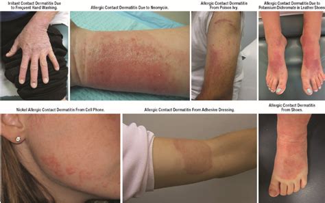 Nomenclature And Clinical Phenotypes Of Atopic Dermatitis 53 OFF