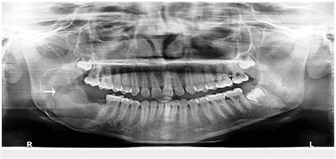 Figure 2 From Ameloblastic Fibro Odontoma Of The Posterior Mandible A