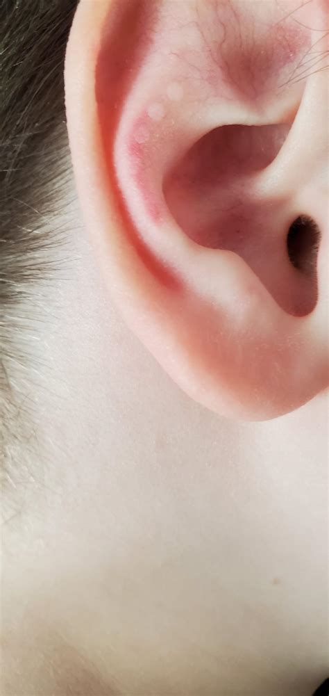 What are these white spots on my son's ears? : r/DermatologyQuestions