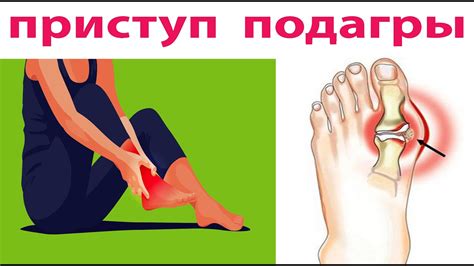 Компресс при подагре, артрите, артрозе. Как снизить уровень мочевой ...