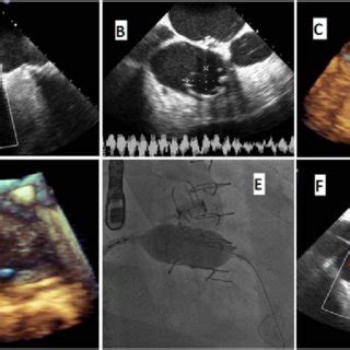 A: Severe TR, failed annuloplasty ring. B: 2D measurement of TV ring ...