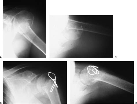 Three Part Fractures And Fracture Dislocations Musculoskeletal Key