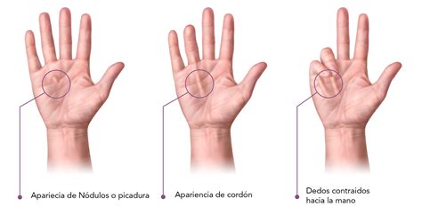 Enfermedad De Dupuytren Corporis Fisioterapia Marbella