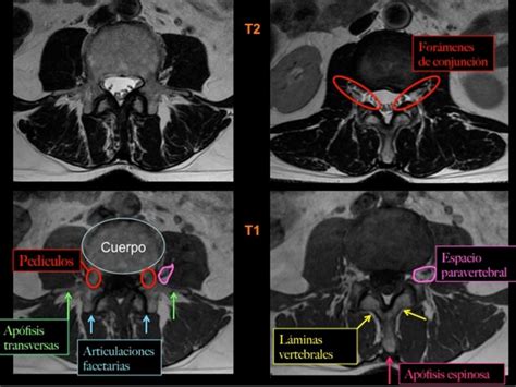 Resonancia Magn Tica Rm O Rmn Para El Estudio Del Dolor En La Zona