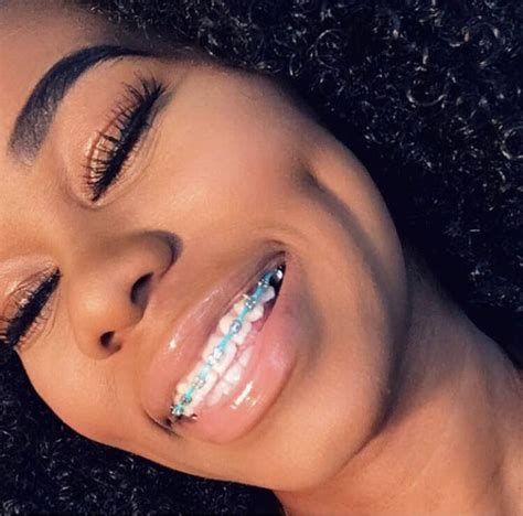 List Of Best Braces Colors For Dark Skin References