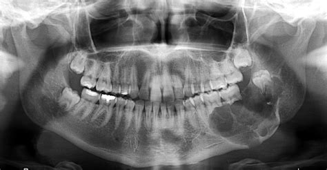 Keratocystic Odontogenic Tumors Clinical And Molecular Features