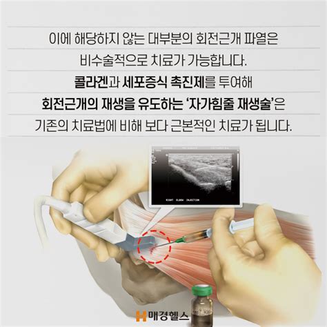 건강스펀지 혼동 주의 오십견vs회전근개 파열