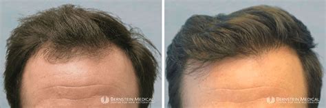 Patient Kjc Bernstein Medical Center For Hair Restoration