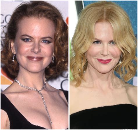 Nicole Kidman Gets a Facelift? Our Plastic Surgery Experts Weigh In ...