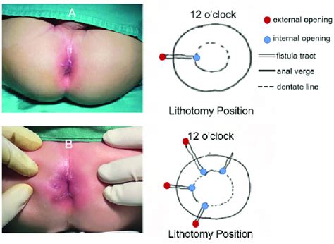 A The Ultrasonographic Record Of Simple Anal Fistulas And B The