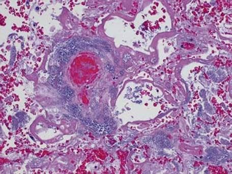 Lobar Pneumonia Histology