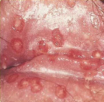 Herpes Genital En La Mujer