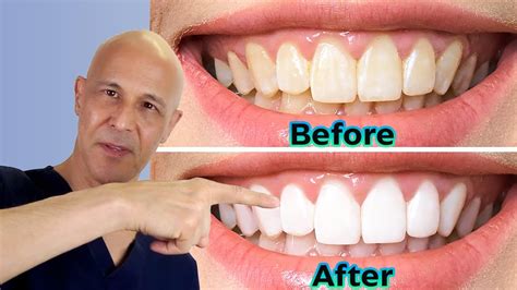 Whiten Your Teeth At Home The Diy Way Dr Mandell Youtube