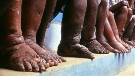 Elephantiasis der äußeren Geschlechtsorgane Ursachen Symptome