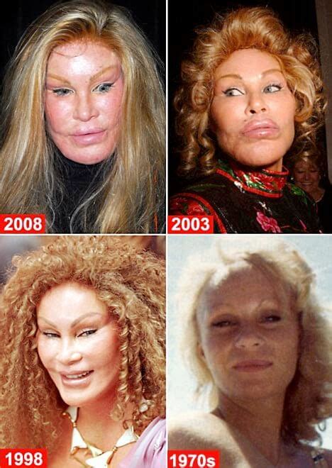 Plastic Surgery Gone Wrong Pictures That Will Make You Feel