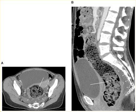 Stercoral Colitis When Constipation Is An Emergency The American