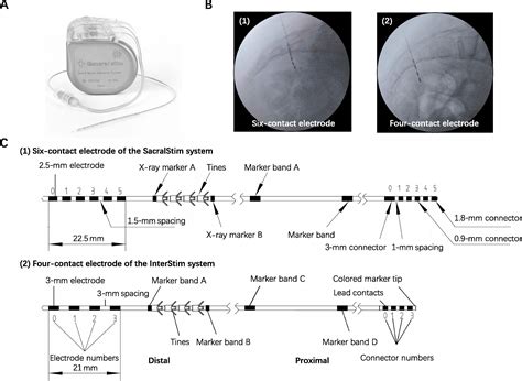 Sacral Neuromodulation Using A Novel Device With A Six Contact Point Electrode For The Treatment