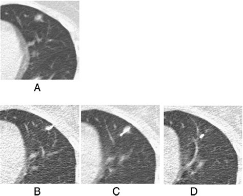 Diagnostic Performance Of Percutaneous Core Needle Lung Biopsy Under Ct