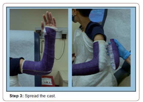 Orthopedic Casting Removal: Quick Techniques | Iris Publishers