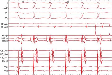 AV Nodal Reentrant Tachycardia Atypical Basicmedical Key