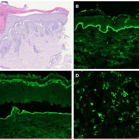 A Histology Showing Subepidermal Blisters And Lymphocytic Infiltrates Download Scientific