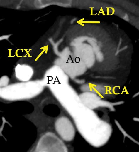 Multimodality Imaging Of Transposition Of The Great Arteries