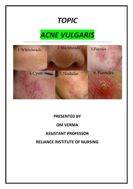 Acne Vulgaris Pdf