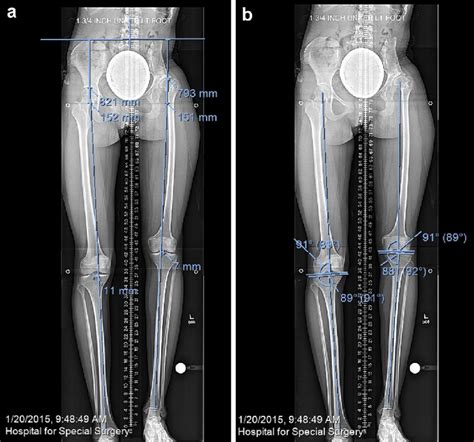 A And B Case 2 Full Length Ap And Lateral Radiographs With