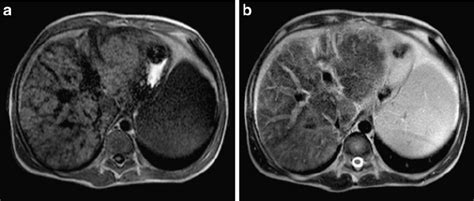 MRI in an 18-year-old boy with a more advanced stage of liver cirrhosis... | Download Scientific ...