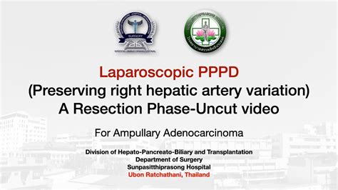 Laparoscopic PPPD For Ampullary Cancer Resection Phase Uncut Video