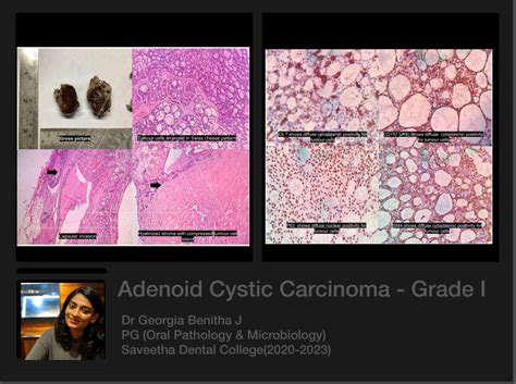 Adenoid Cystic Carcinoma — Oral Pathology Saveetha