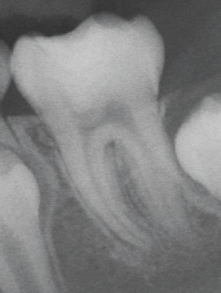 Periapical Radiographs Recorded A Before Treatment B Immediately