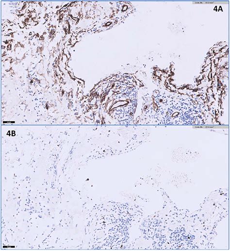 A The CD34 Immunohistochemical Stain Appears Positive Lining The