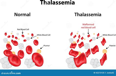 Thalassemia Cartoons Illustrations Vector Stock Images 5 Pictures