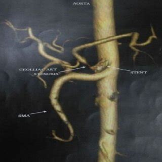 Stent placement for celiac artery stenosis | Download Scientific Diagram