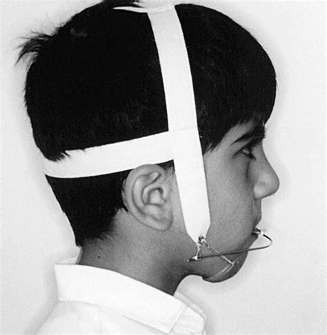 Design And Fabrication Of A Modified Protraction Headgear For Class Iii Long Face Patients