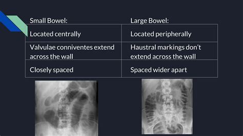 approach   ray abdomen  kubpptx