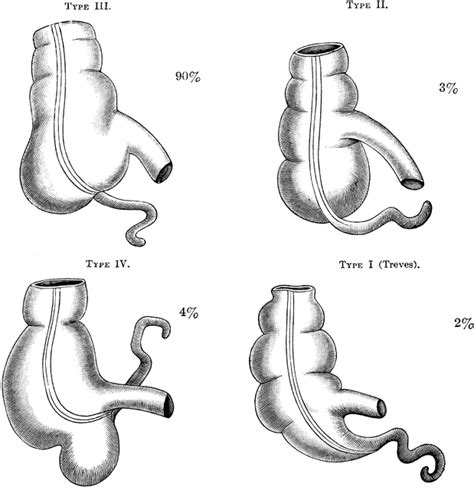 Four Types Of Cecum Clipart Etc