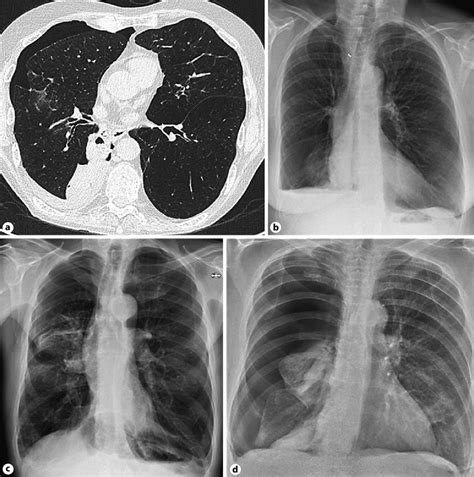 a Pneumothorax ex vacuo on a chest CT scan after valve treatment in the ...