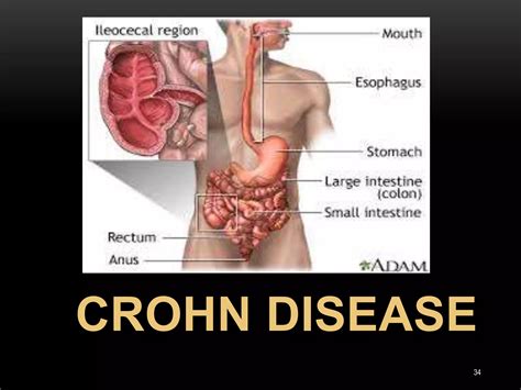 Pathology Of Inflammatory Bowel Disease Ppt