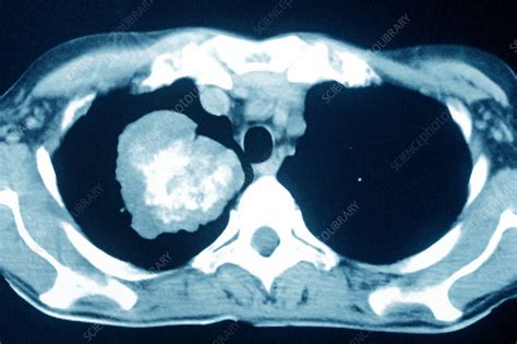 Smoking Related Lung Cancer Ct Scan Stock Image C0389030