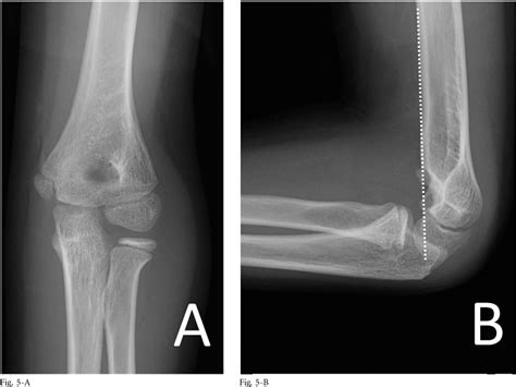 Gartland Type Iii Pediatric Supracondylar Humerus Fracture With Radial